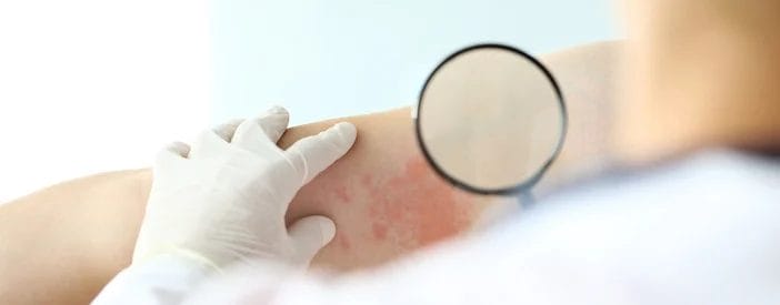 large Template herpes zoster Il Fuoco di Sant'Antonio: cos'è e perché dovresti preoccupartene